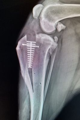 X-ray of repaired cruciate ligament 